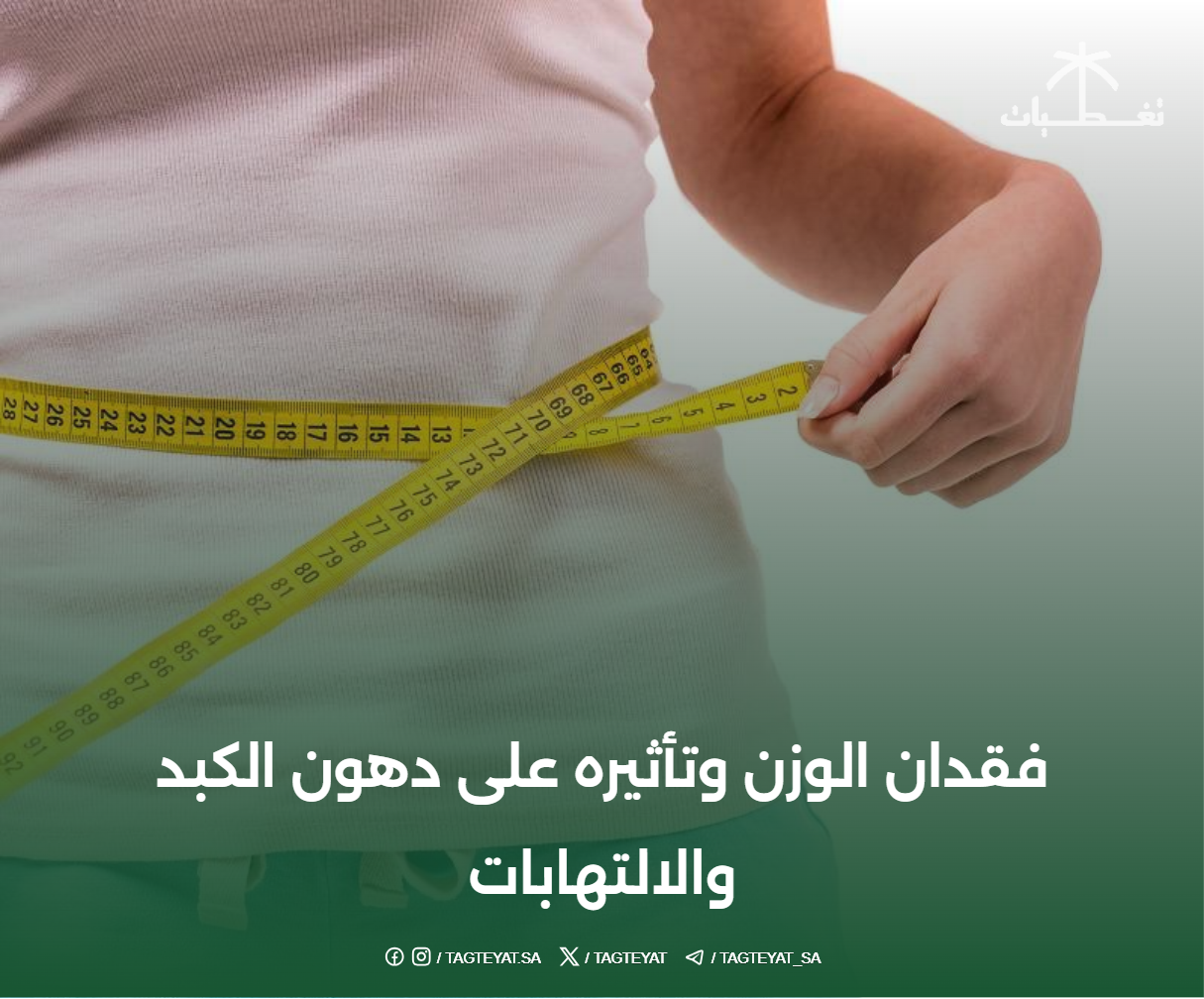 فقدان الوزن وتأثيره على دهون الكبد والالتهابات