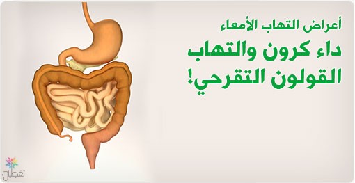 تقنية النانو العلاج الحديث لالتهاب القولون