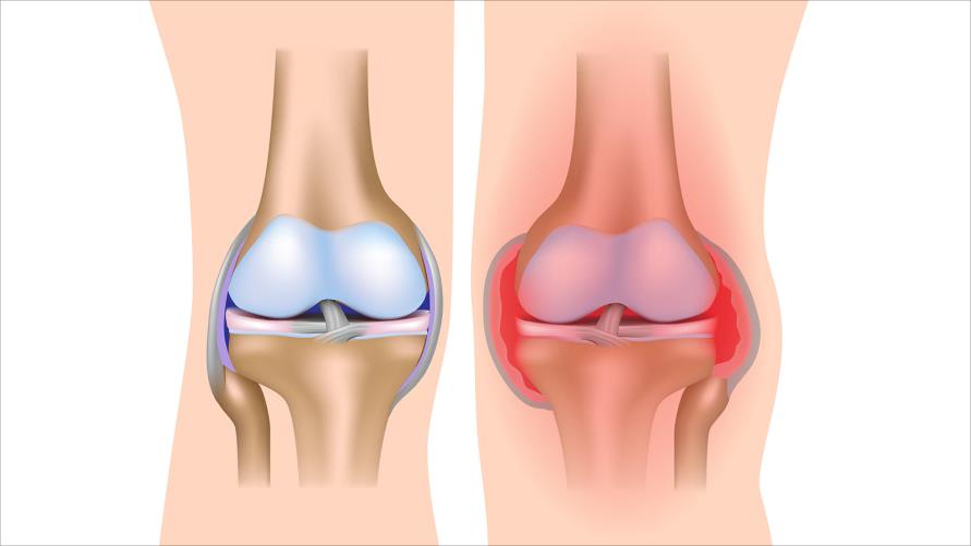 6 علاجات طبيعية لإلتهاب المفاصل الروماتيزي